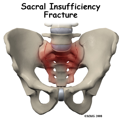 Physical Therapy in California South Bay for Sacral Insufficiency